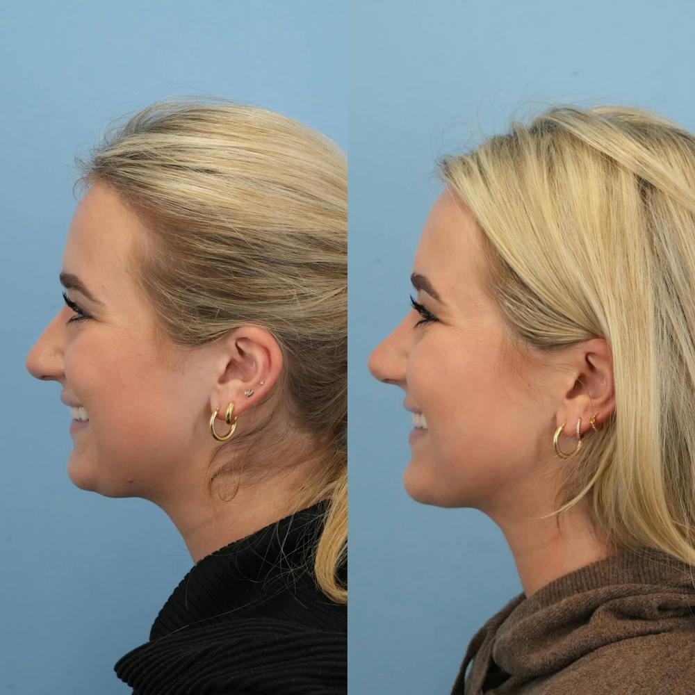 Rhinoplasty Before & After Gallery - Patient 130441 - Image 3