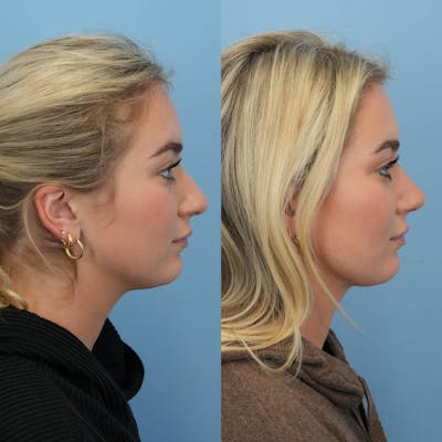 Rhinoplasty Before & After Gallery - Patient 130441 - Image 6