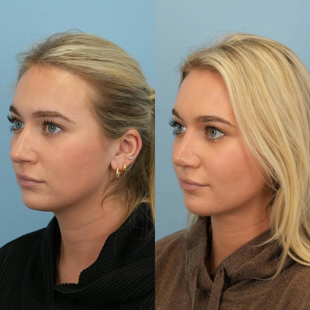Rhinoplasty Before & After Gallery - Patient 130441 - Image 4