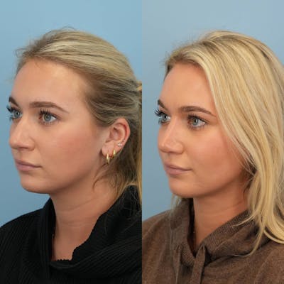 Rhinoplasty Before & After Gallery - Patient 130441 - Image 4