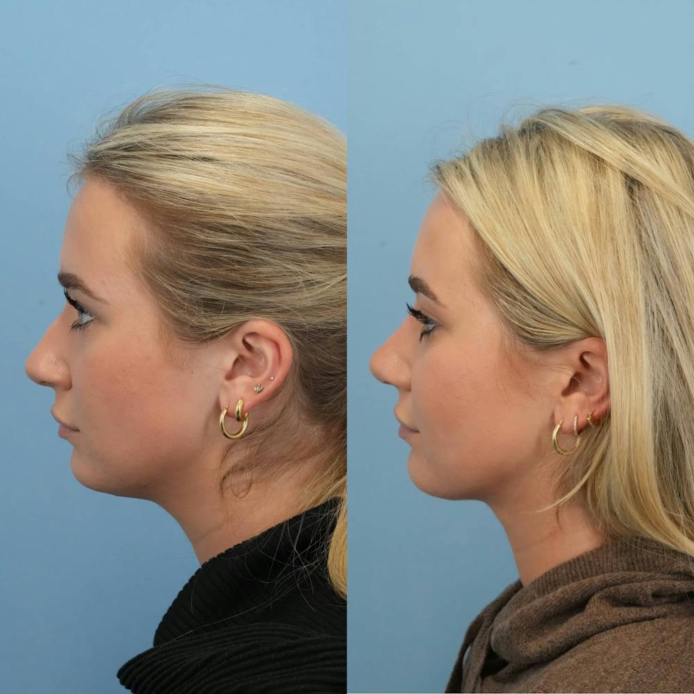 Rhinoplasty Before & After Gallery - Patient 130441 - Image 2