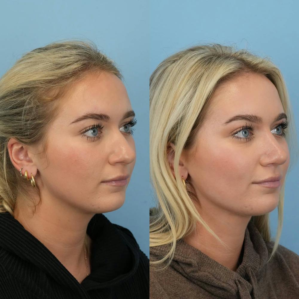 Rhinoplasty Before & After Gallery - Patient 130441 - Image 5