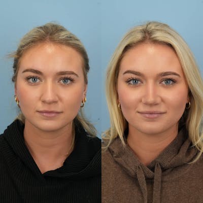 Rhinoplasty Before & After Gallery - Patient 130441 - Image 1