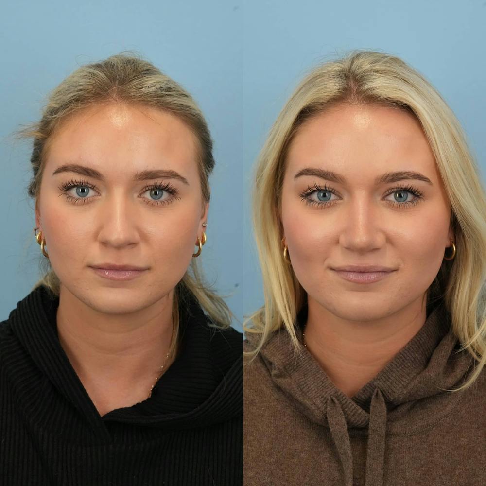 Rhinoplasty Before & After Gallery - Patient 130441 - Image 1