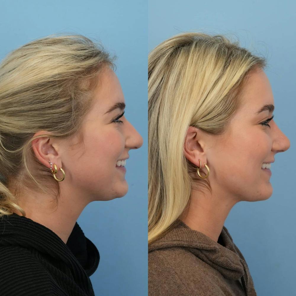 Rhinoplasty Before & After Gallery - Patient 130441 - Image 7