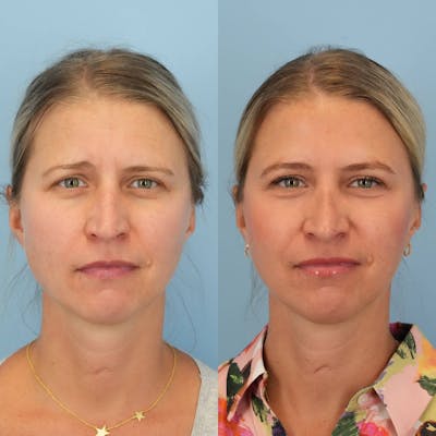 Rhinoplasty Before & After Gallery - Patient 279708 - Image 1