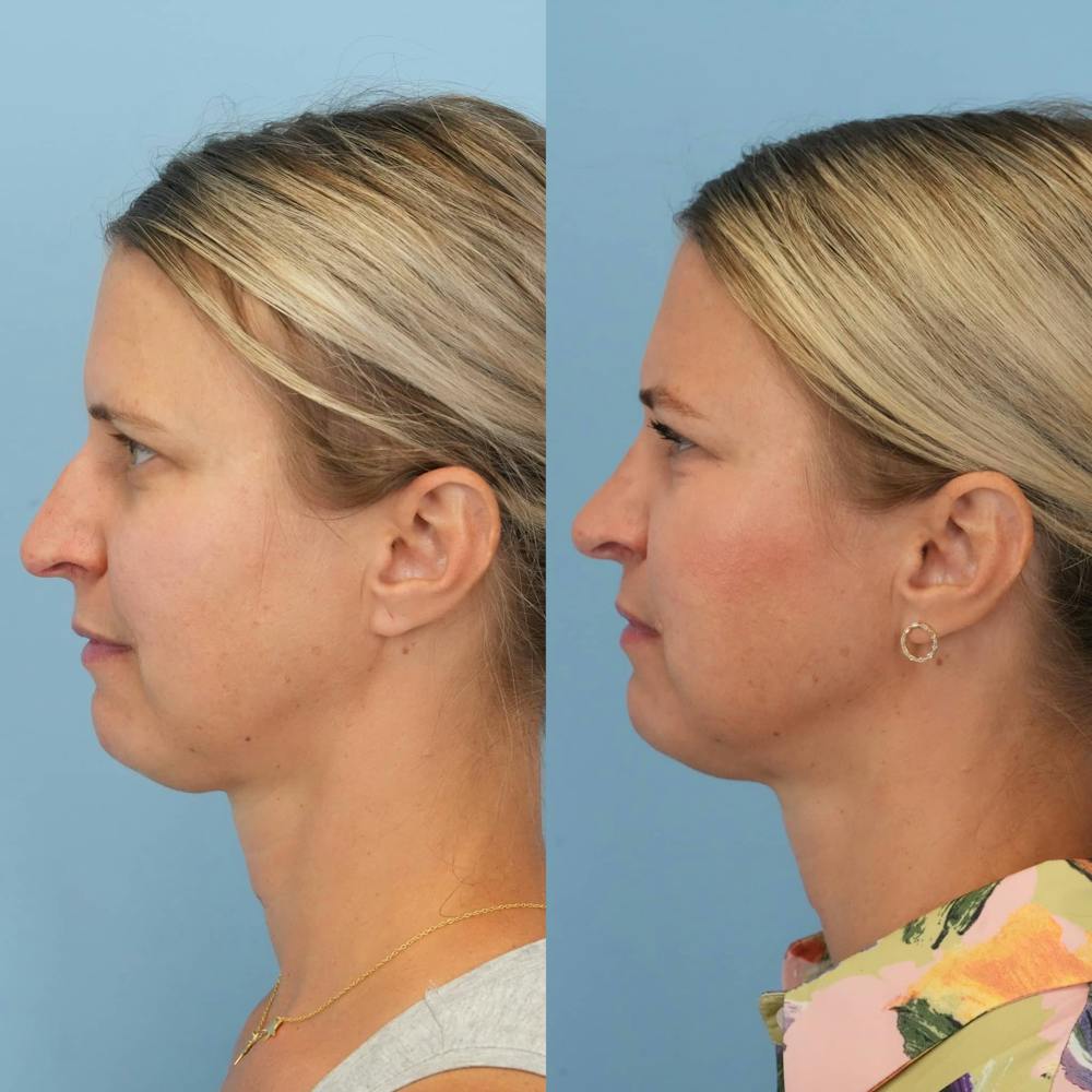 Rhinoplasty Before & After Gallery - Patient 279708 - Image 3