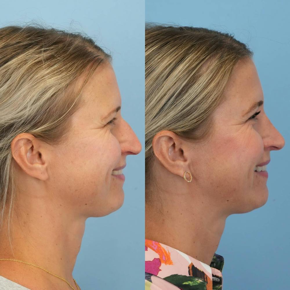 Rhinoplasty Before & After Gallery - Patient 279708 - Image 7