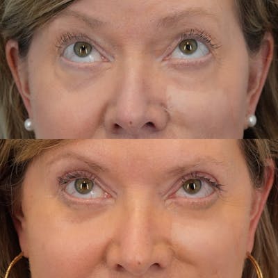 Blepharoplasty Before & After Gallery - Patient 162282 - Image 1