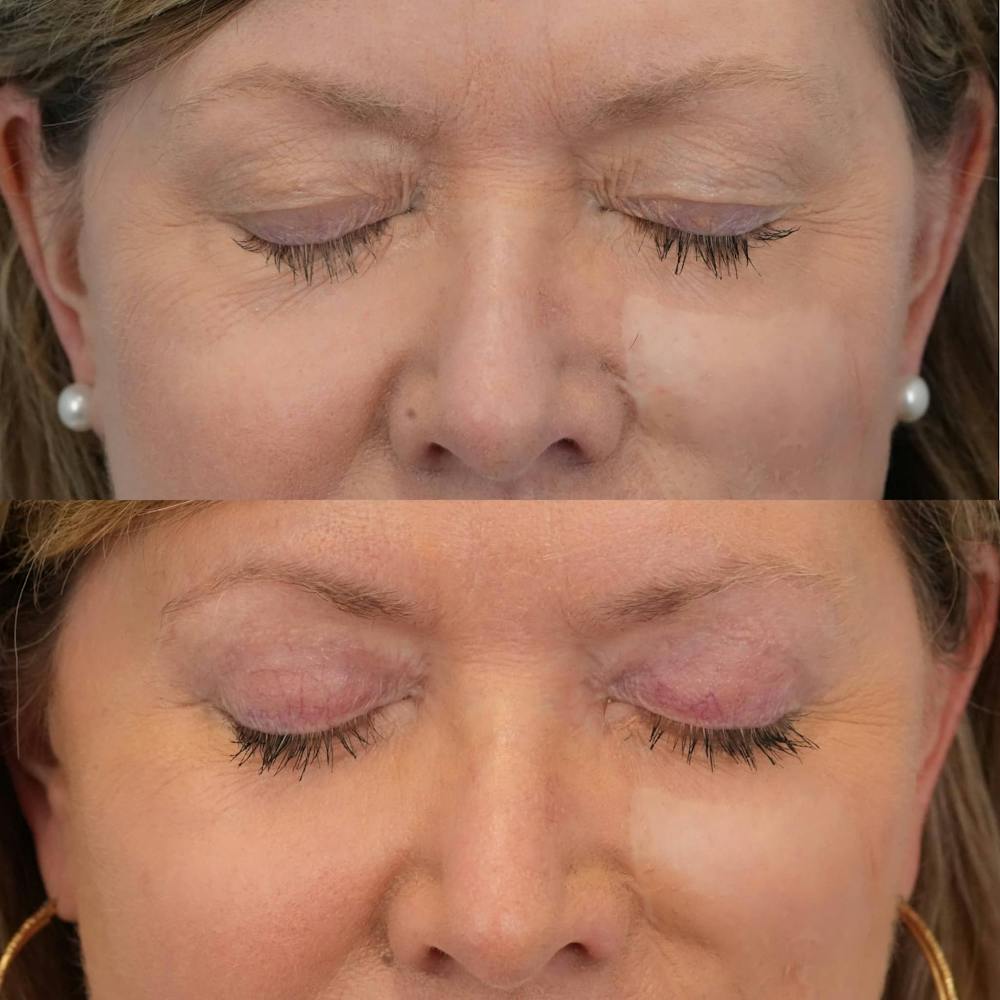 Blepharoplasty Before & After Gallery - Patient 162282 - Image 2