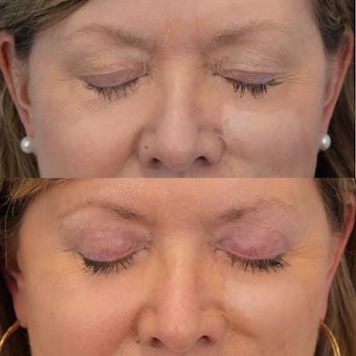 Blepharoplasty Before & After Gallery - Patient 162282 - Image 2