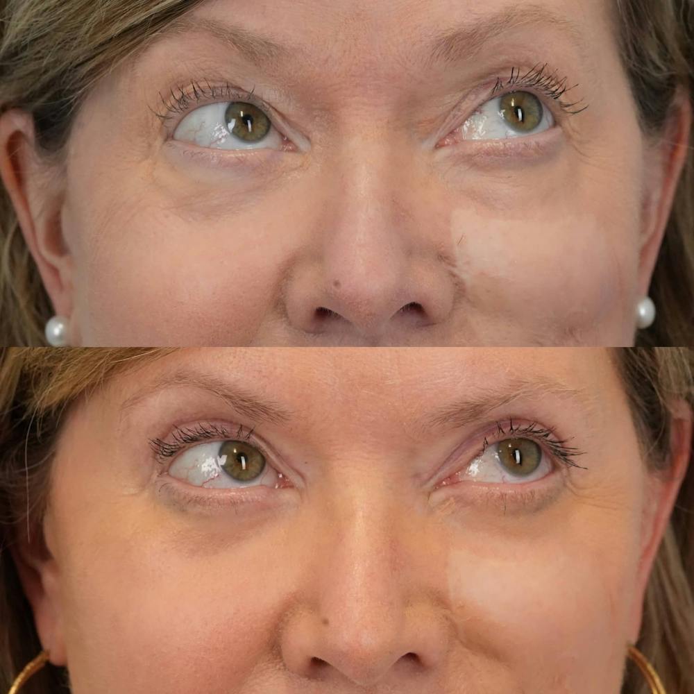 Blepharoplasty Before & After Gallery - Patient 162282 - Image 3