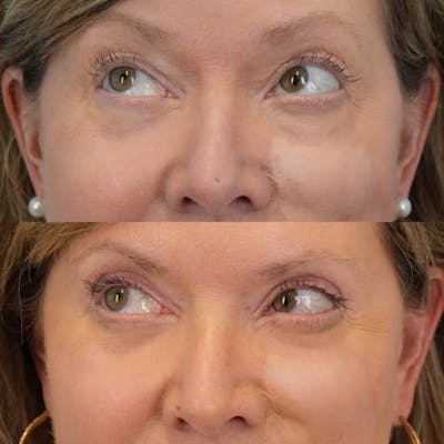 Blepharoplasty Before & After Gallery - Patient 162282 - Image 4