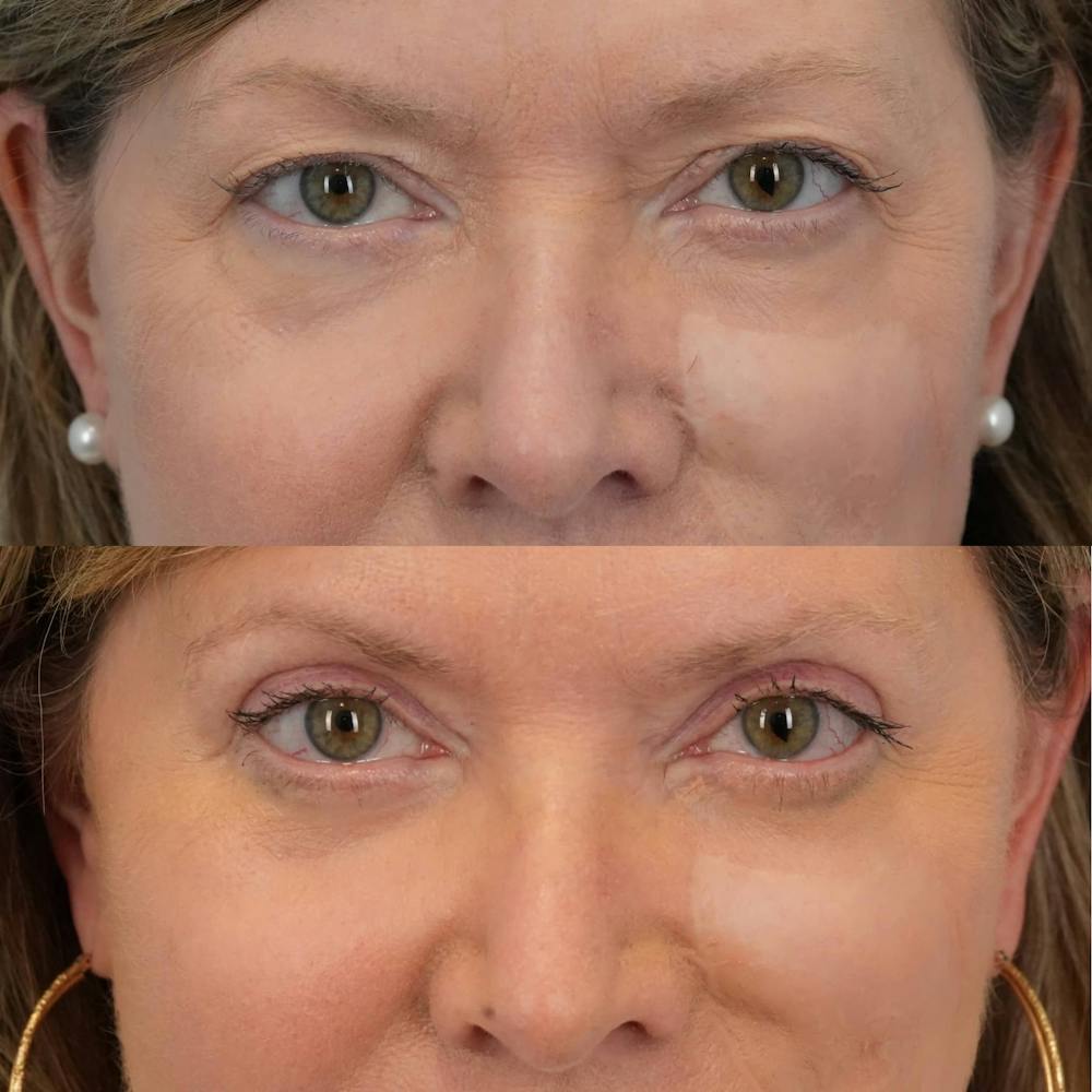 Blepharoplasty Before & After Gallery - Patient 162282 - Image 5