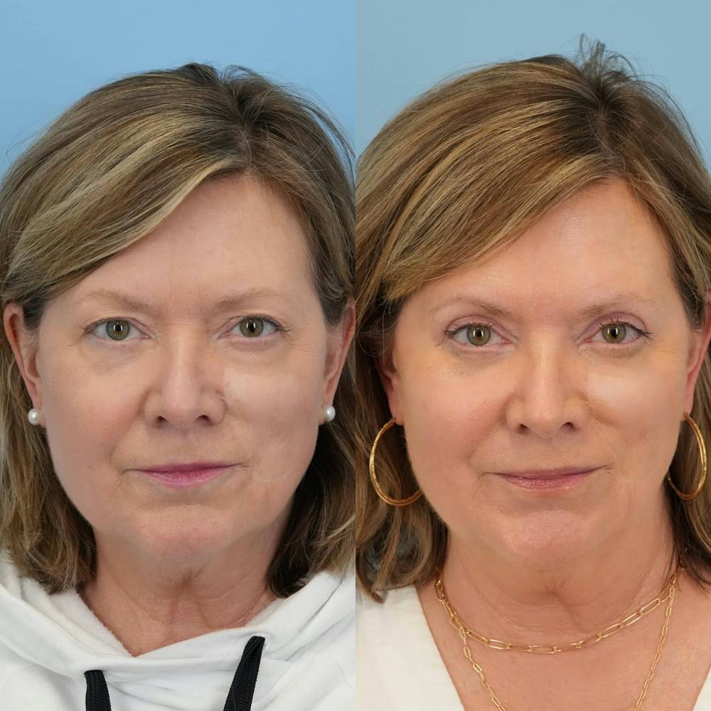 Blepharoplasty Before & After Gallery - Patient 162282 - Image 6