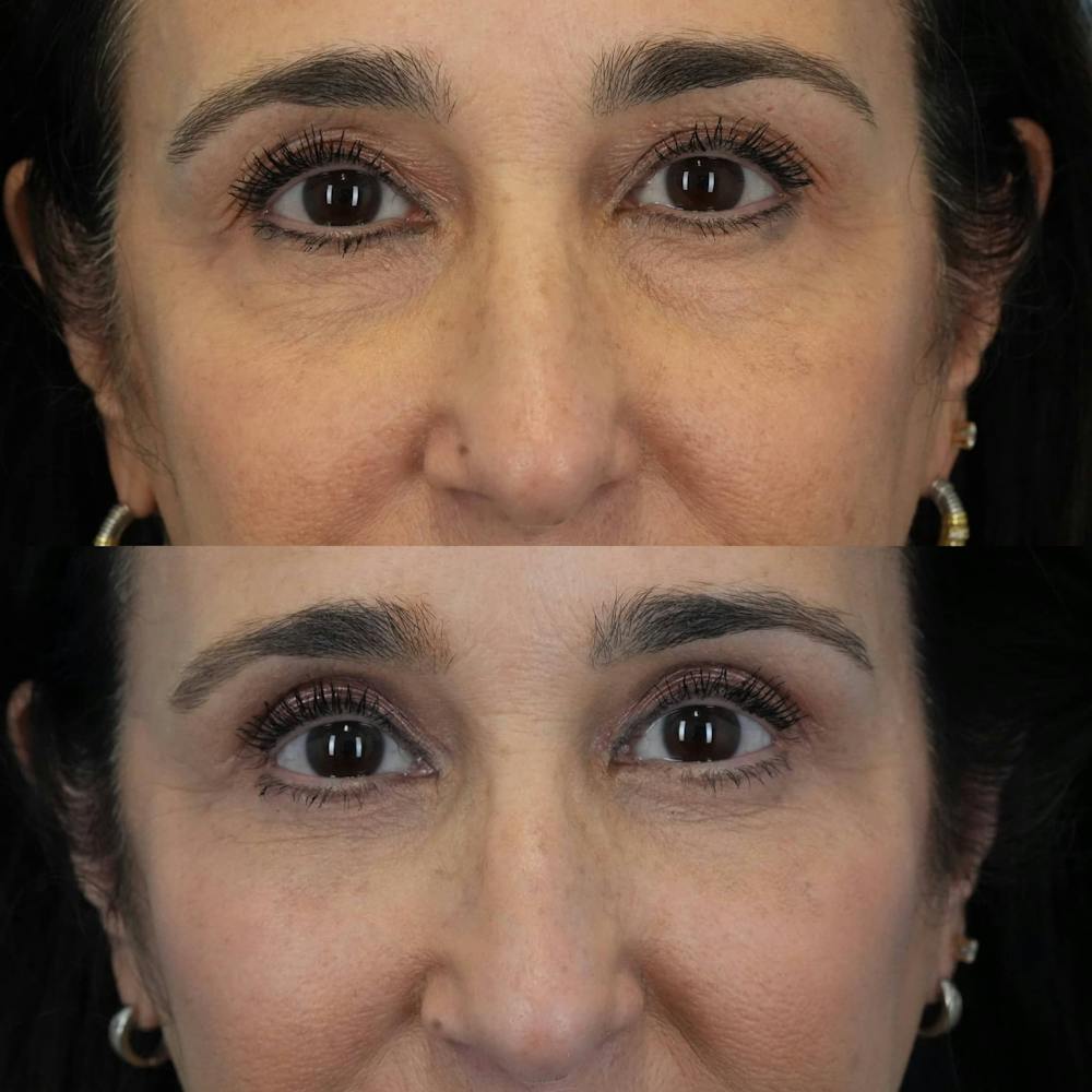 Blepharoplasty Before & After Gallery - Patient 375281 - Image 1