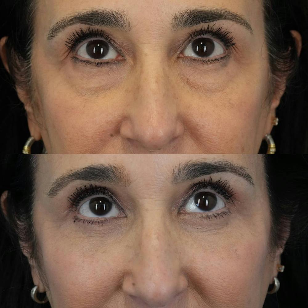 Blepharoplasty Before & After Gallery - Patient 375281 - Image 2