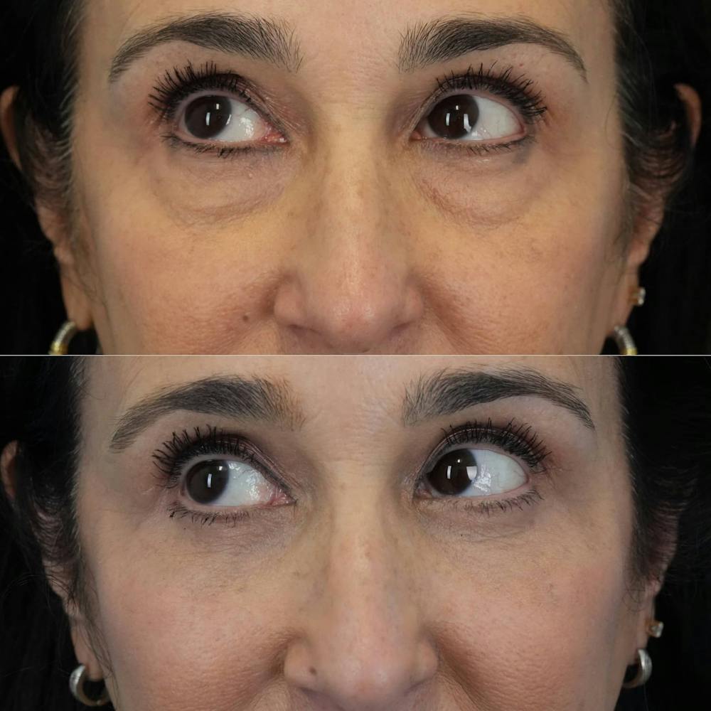 Blepharoplasty Before & After Gallery - Patient 375281 - Image 3