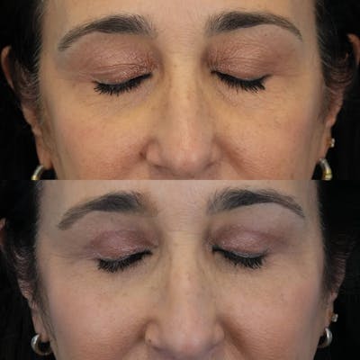 Blepharoplasty Before & After Gallery - Patient 375281 - Image 4