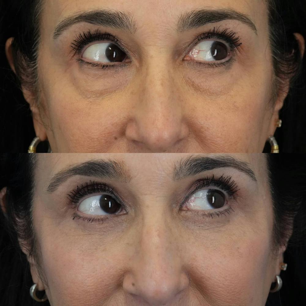 Blepharoplasty Before & After Gallery - Patient 375281 - Image 5