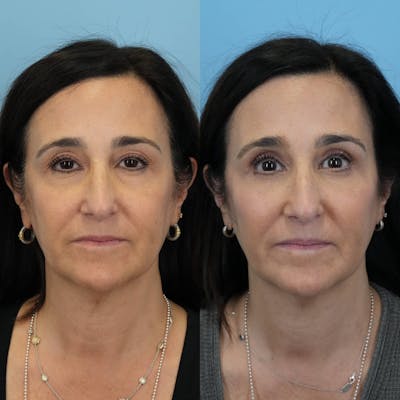 Blepharoplasty Before & After Gallery - Patient 375281 - Image 6