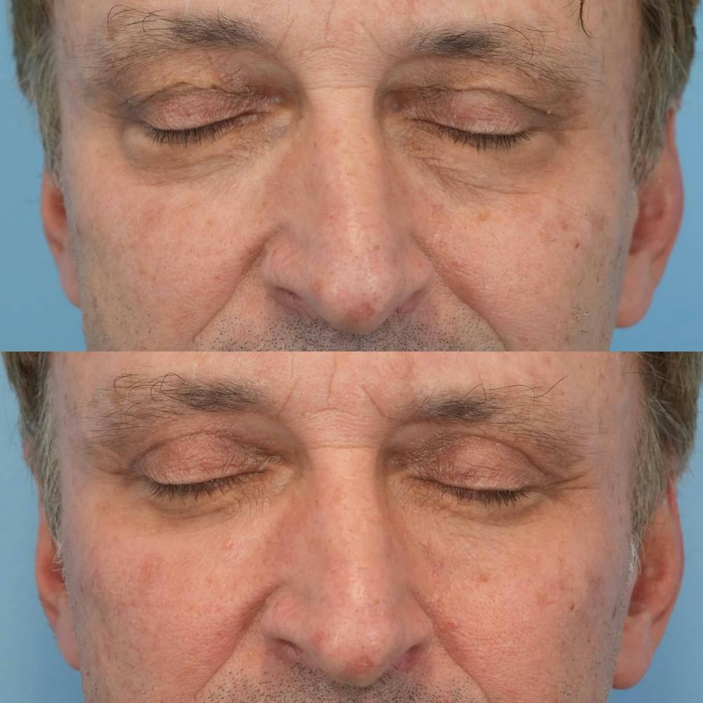 Blepharoplasty Before & After Gallery - Patient 343524 - Image 2