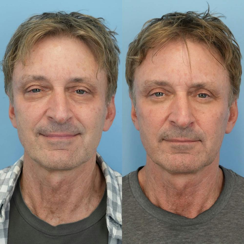 Blepharoplasty Before & After Gallery - Patient 343524 - Image 3