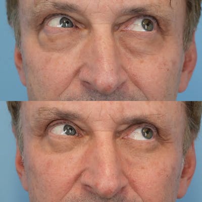 Blepharoplasty Before & After Gallery - Patient 343524 - Image 4