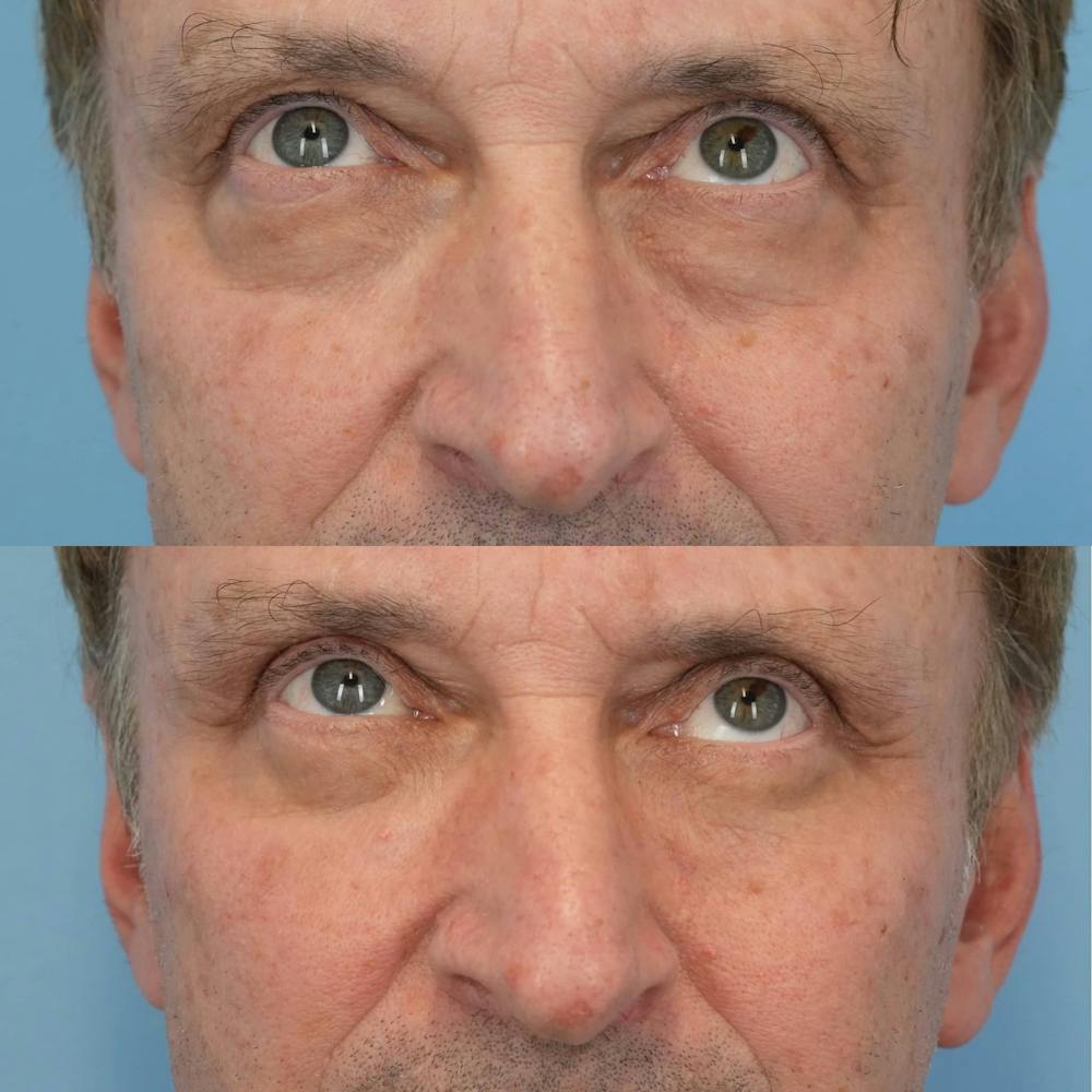 Blepharoplasty Before & After Gallery - Patient 343524 - Image 5