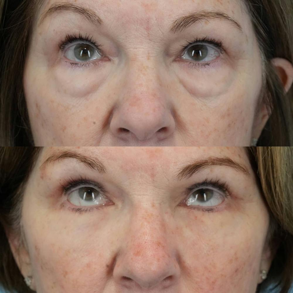 Blepharoplasty Before & After Gallery - Patient 406726 - Image 1