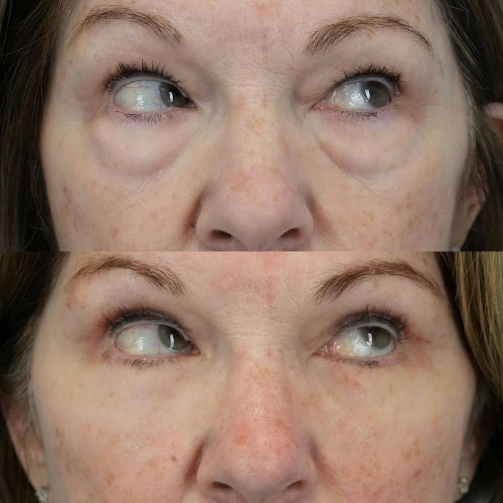 Blepharoplasty Before & After Gallery - Patient 406726 - Image 2