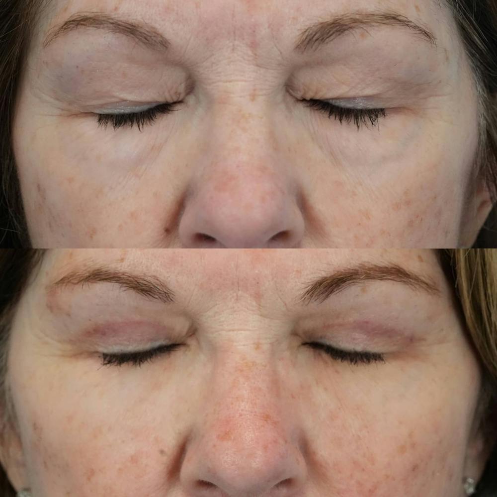 Blepharoplasty Before & After Gallery - Patient 406726 - Image 3