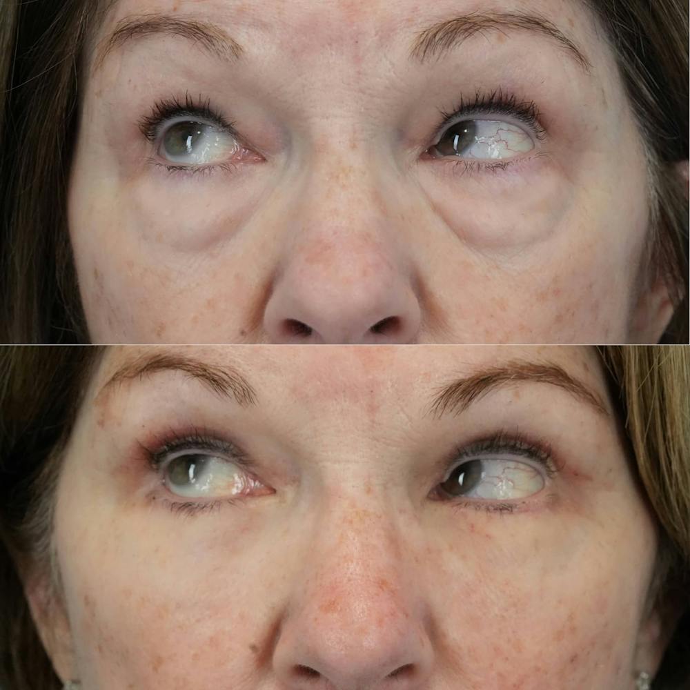 Blepharoplasty Before & After Gallery - Patient 406726 - Image 4