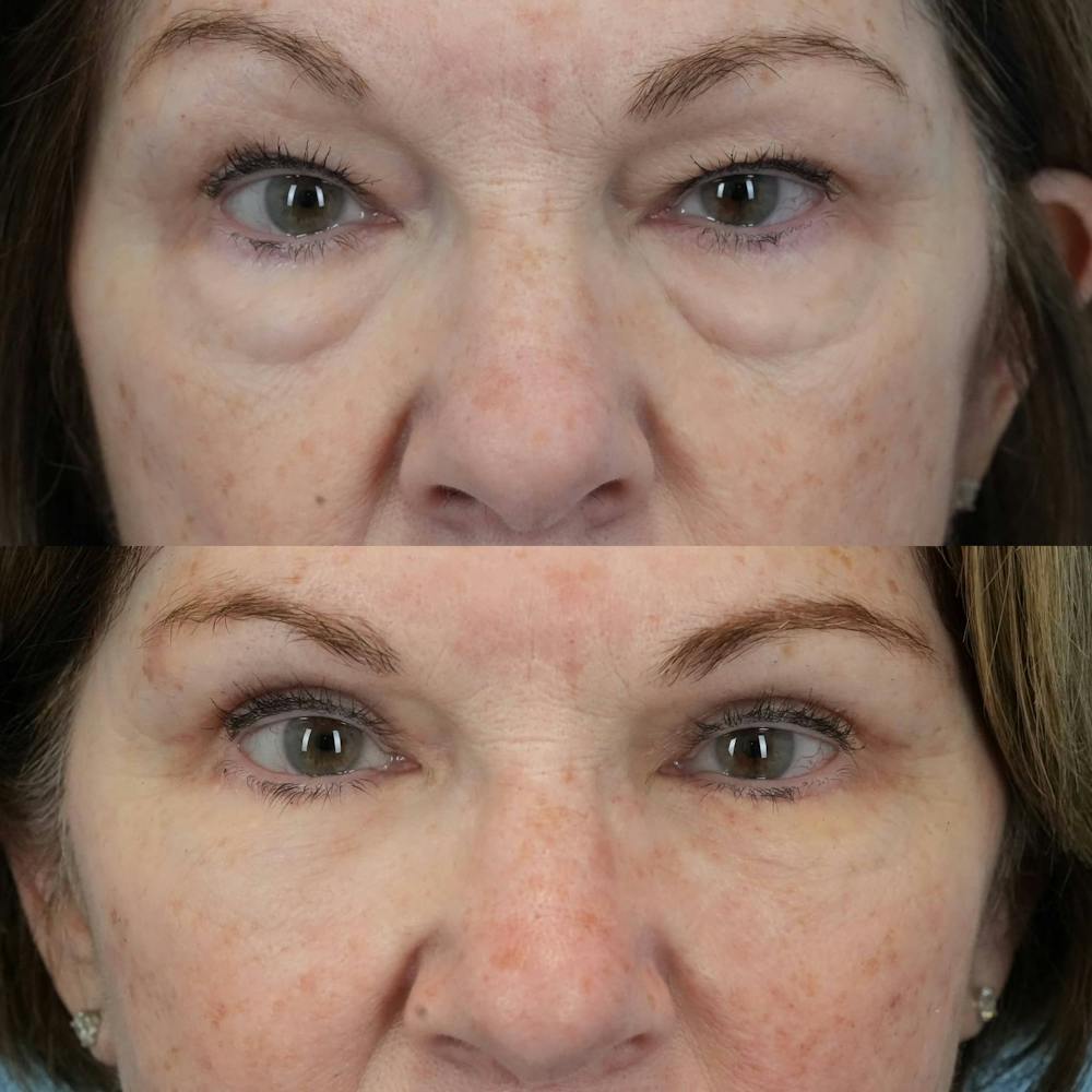 Blepharoplasty Before & After Gallery - Patient 406726 - Image 5