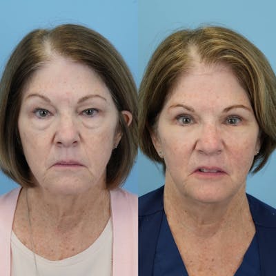 Blepharoplasty Before & After Gallery - Patient 406726 - Image 6