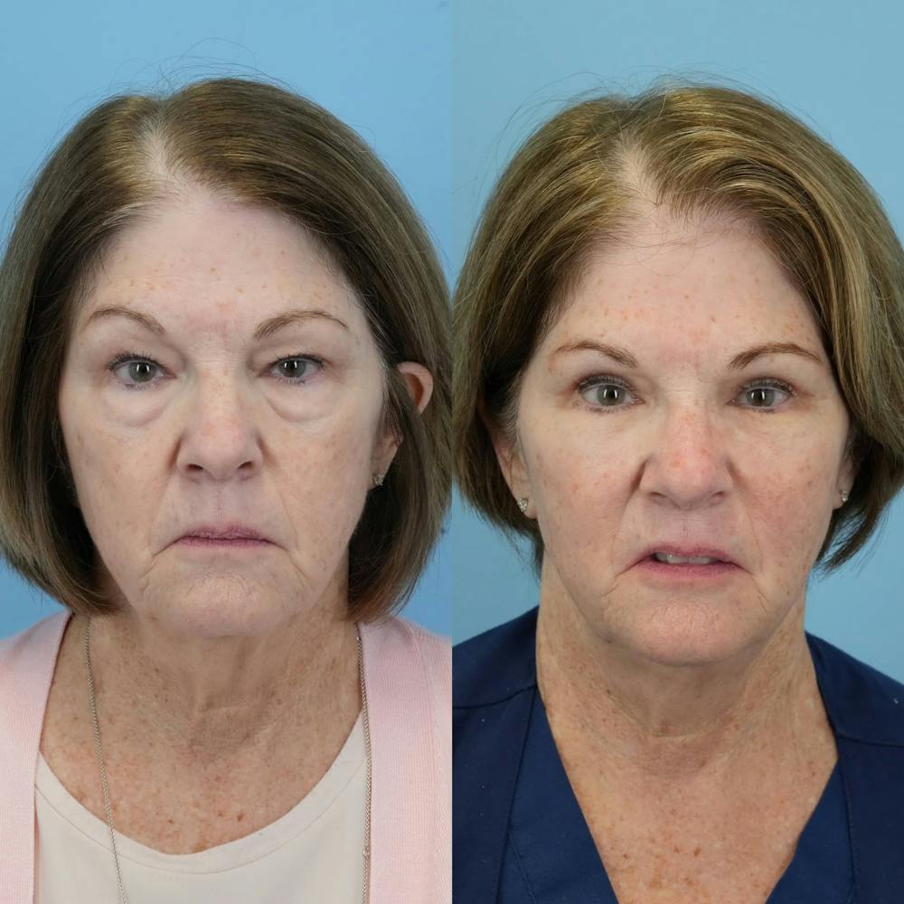 Blepharoplasty Before & After Gallery - Patient 406726 - Image 6