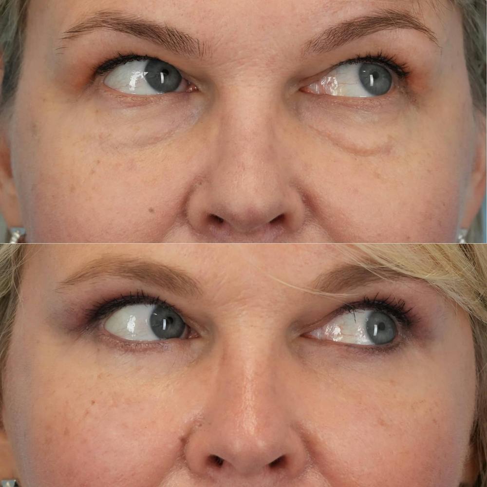 Blepharoplasty Before & After Gallery - Patient 790810 - Image 2