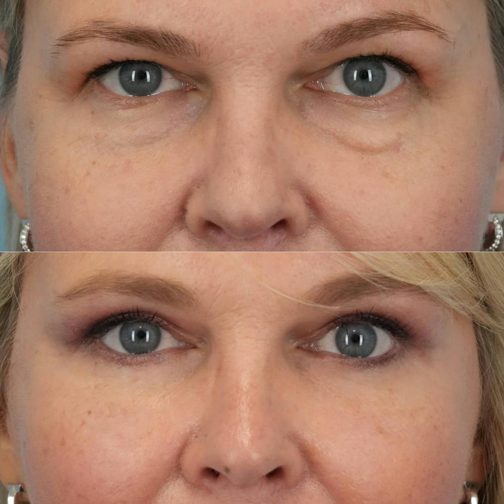 Blepharoplasty Before & After Gallery - Patient 790810 - Image 3