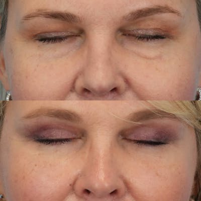 Blepharoplasty Before & After Gallery - Patient 790810 - Image 4