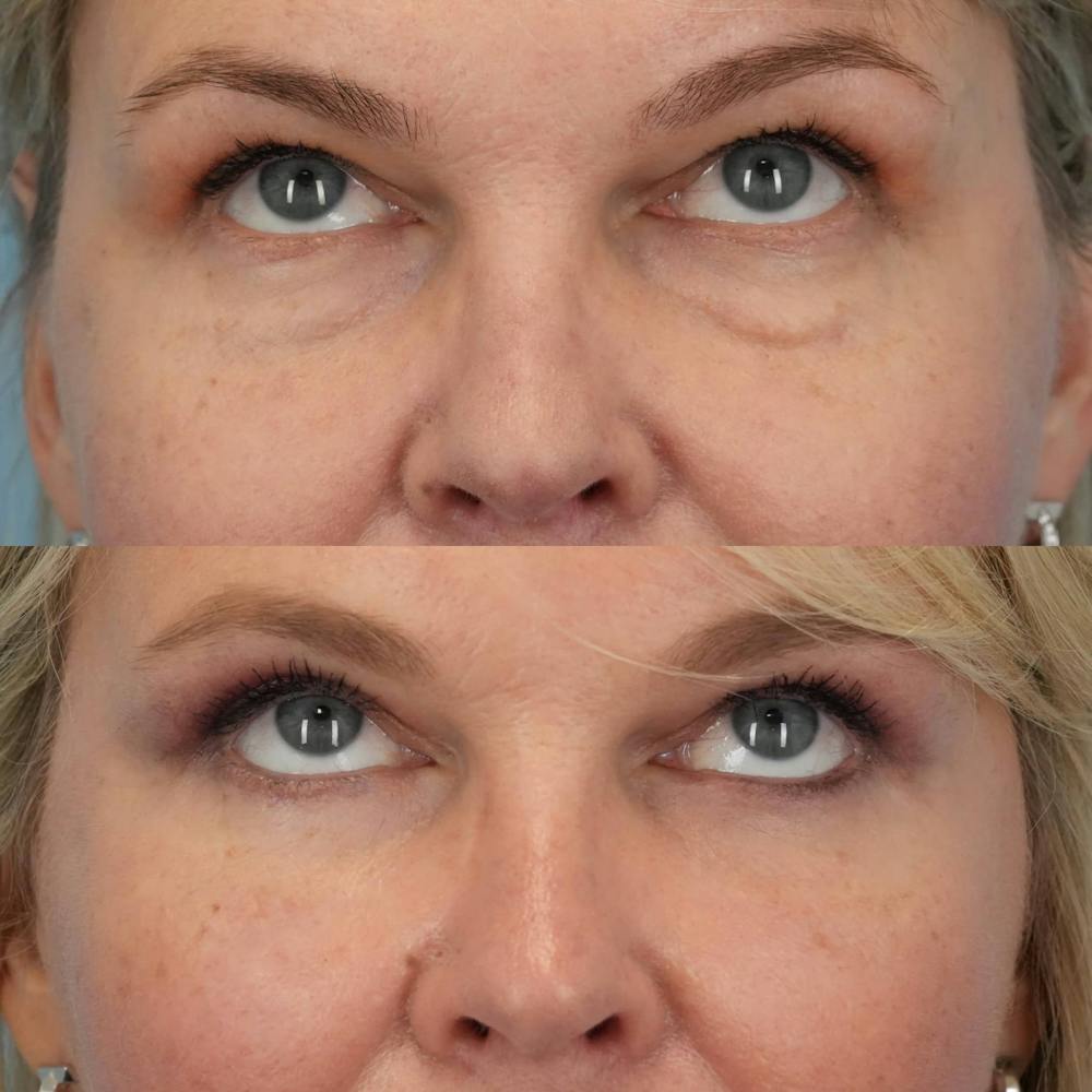 Blepharoplasty Before & After Gallery - Patient 790810 - Image 5