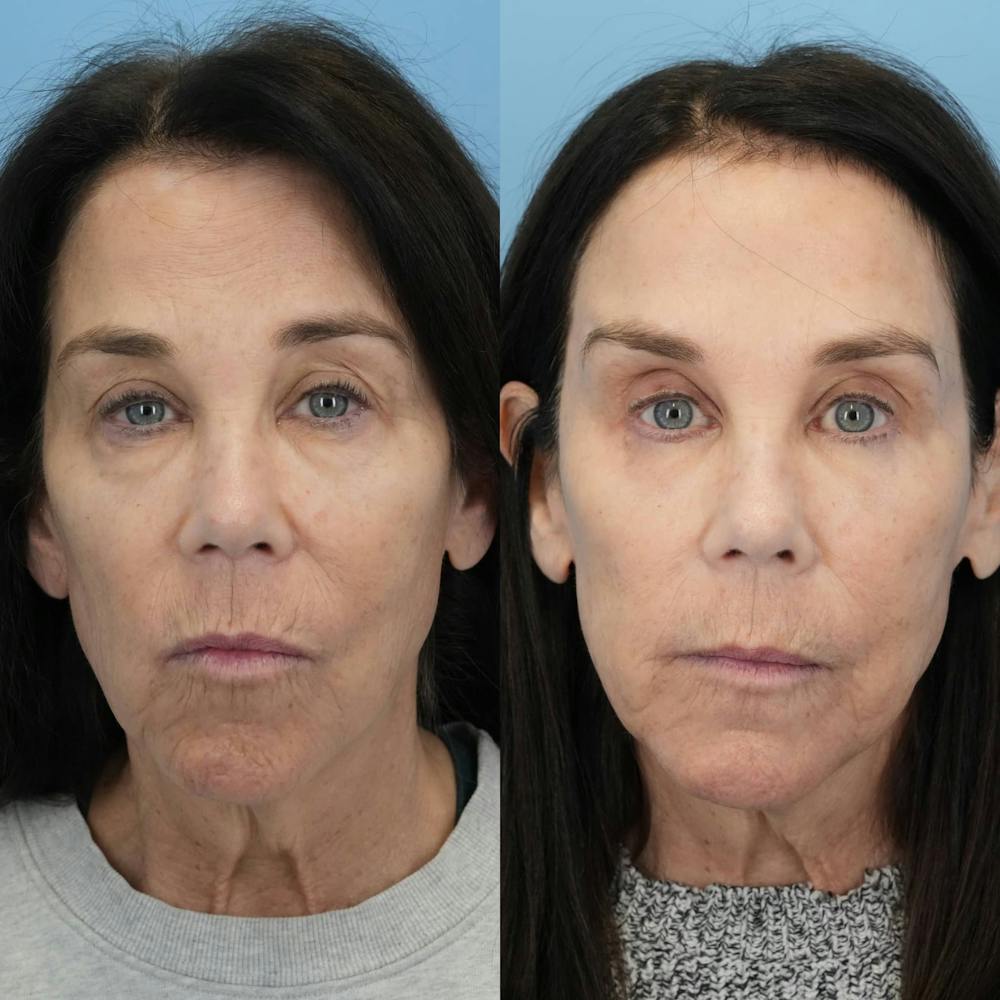 Blepharoplasty Before & After Gallery - Patient 131000 - Image 5