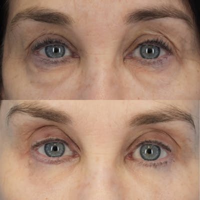 Blepharoplasty Before & After Gallery - Patient 131000 - Image 1