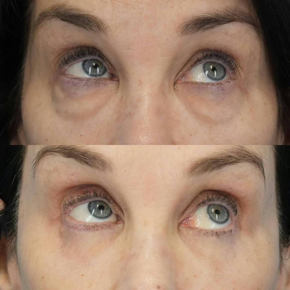 Blepharoplasty Before & After Gallery - Patient 131000 - Image 2