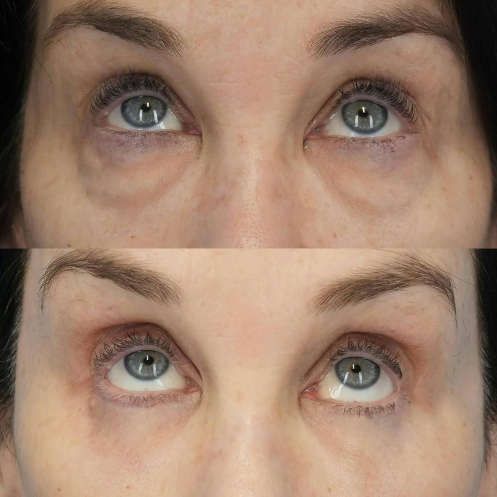 Blepharoplasty Before & After Gallery - Patient 131000 - Image 3