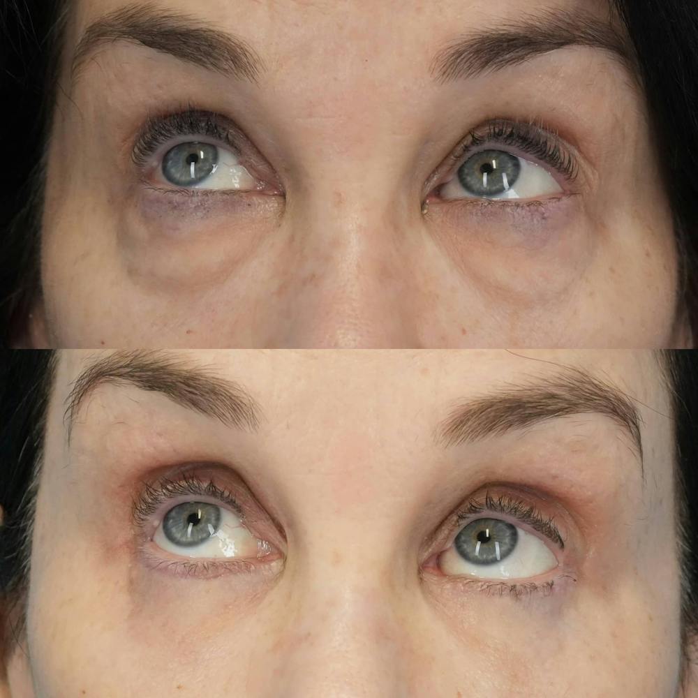 Blepharoplasty Before & After Gallery - Patient 131000 - Image 4
