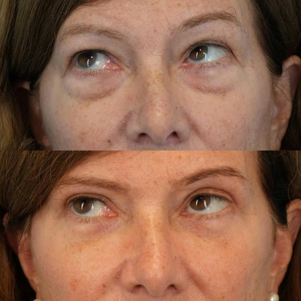 Blepharoplasty Before & After Gallery - Patient 195281 - Image 2
