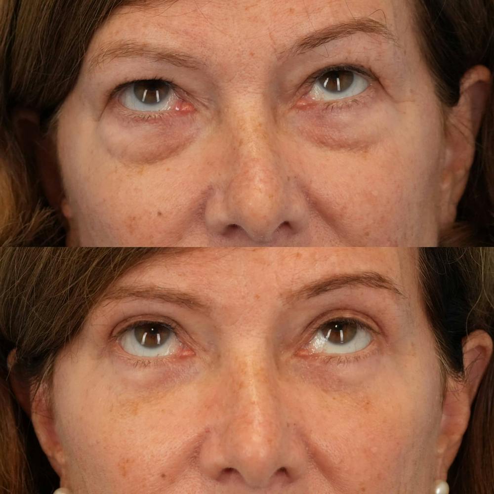 Blepharoplasty Before & After Gallery - Patient 195281 - Image 3