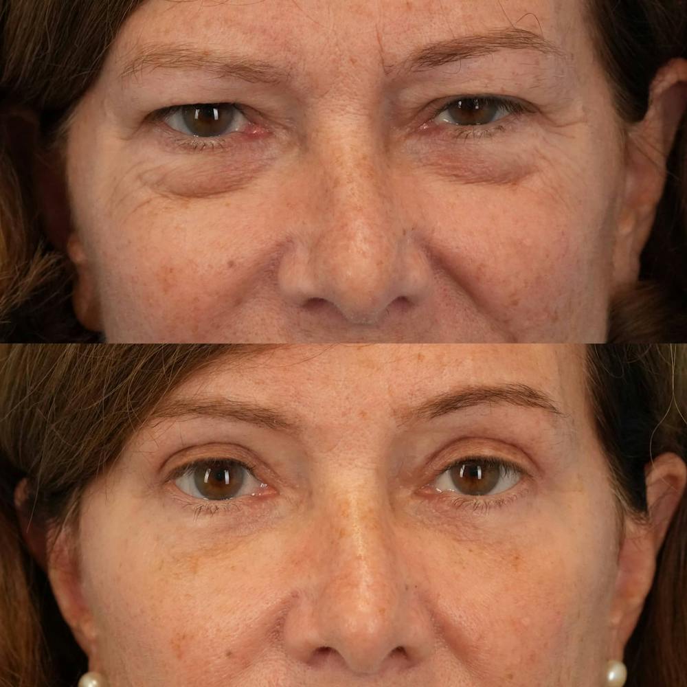 Blepharoplasty Before & After Gallery - Patient 195281 - Image 1