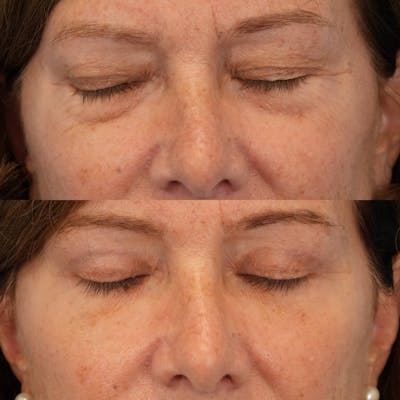 Blepharoplasty Before & After Gallery - Patient 195281 - Image 4