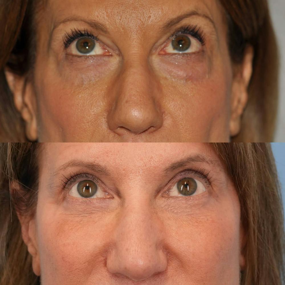 Blepharoplasty Before & After Gallery - Patient 234495 - Image 2